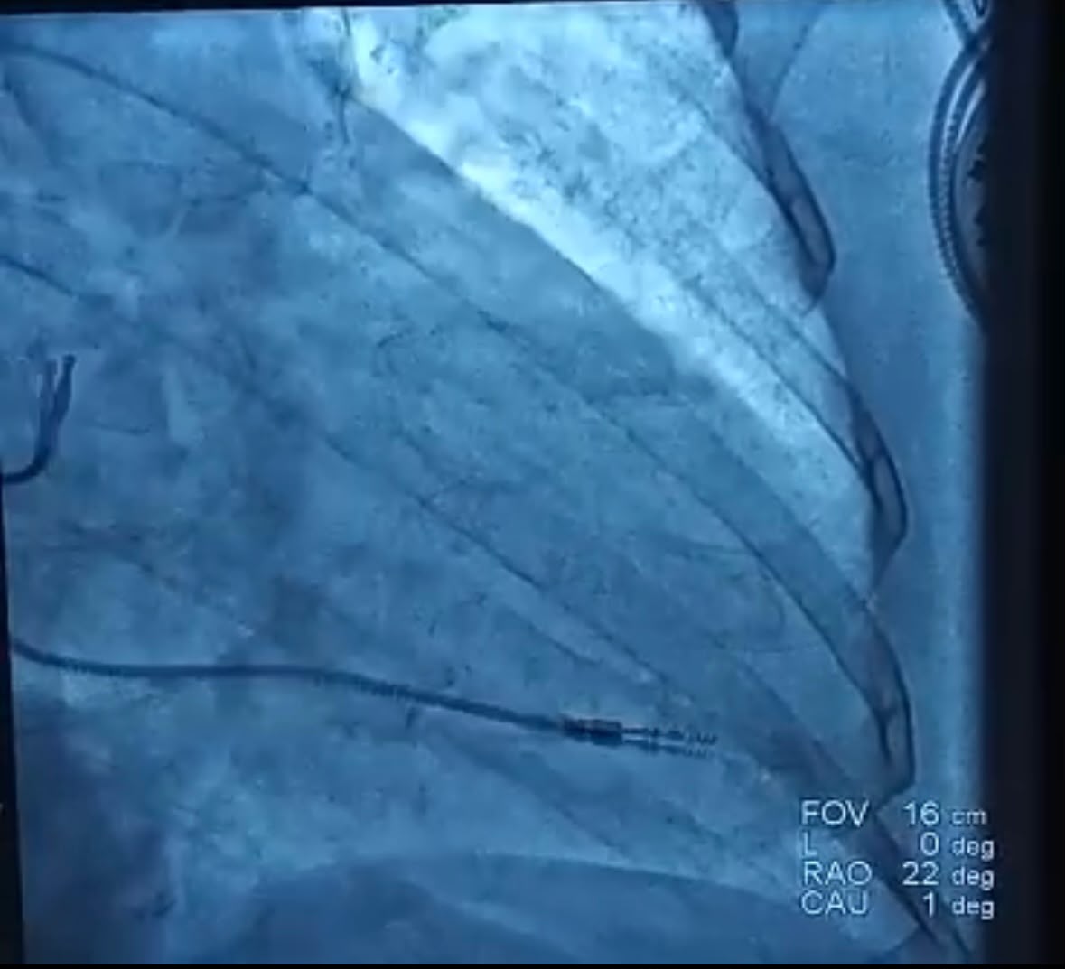 Fluoroscopic lead fixation inside heart chambers during double pacemaker surgery at NTC Hospital Madurai