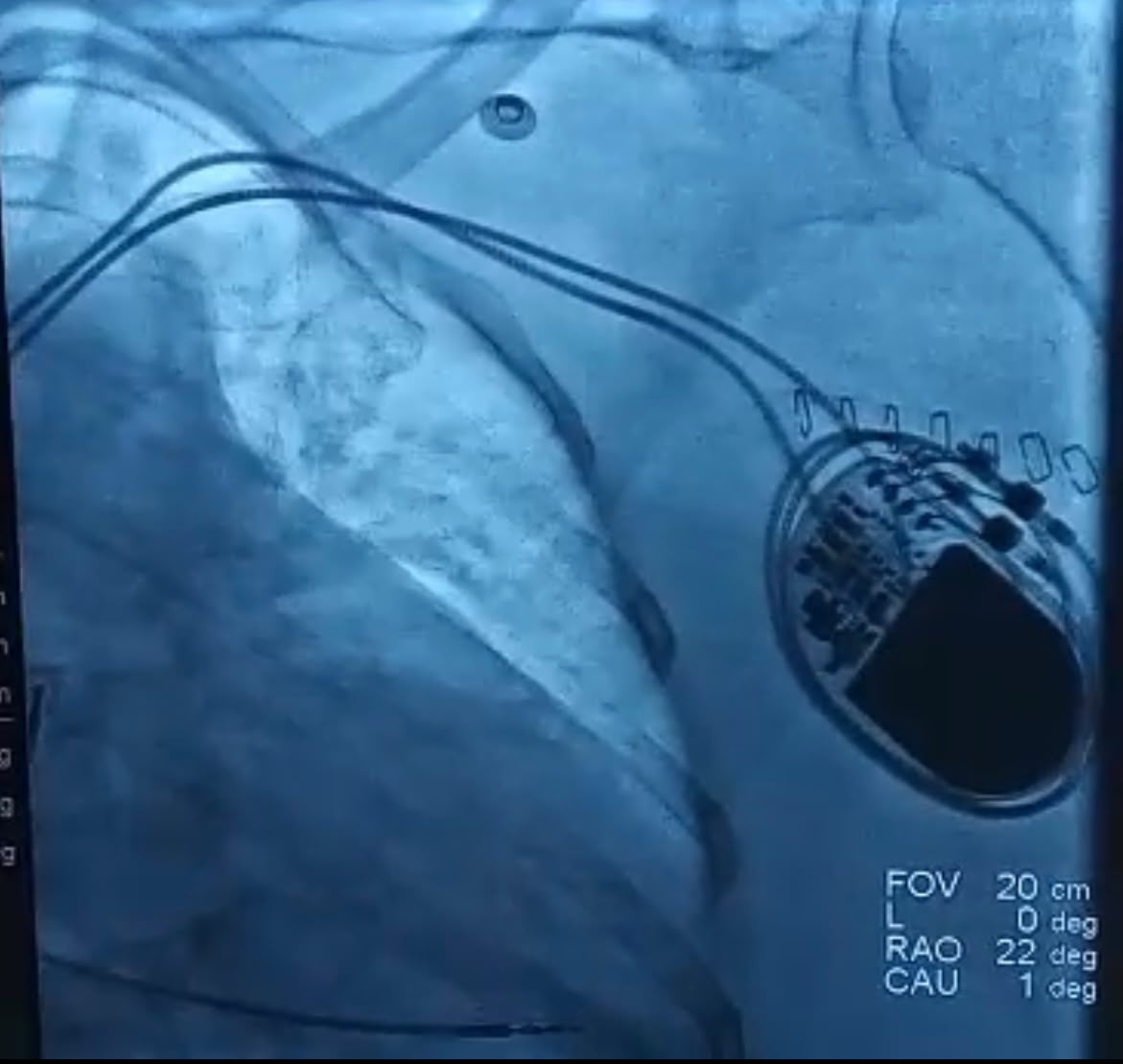 Fluoroscopy image of double pacemaker surgery pulse generator at NTC Hospital Madurai